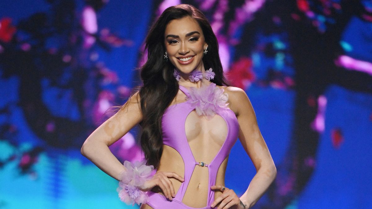 Kožní onemocnění už Veronica Biasiol neskrývá: Takhle jí to seklo na světové soutěži krásy, kde bodovala v bikinách