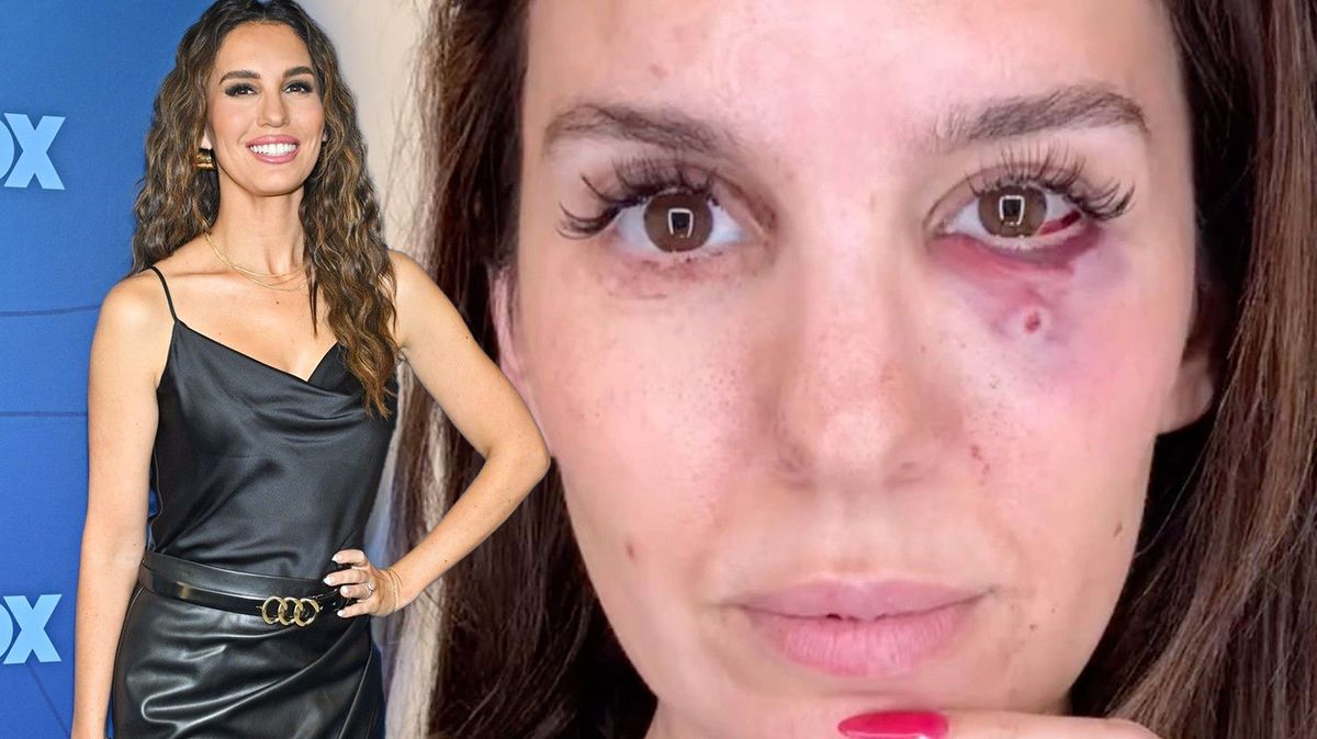 Děsivá nehoda dětské herecké hvězdy: Na oslavě ji postřelili do obličeje, herečka ukázala foto