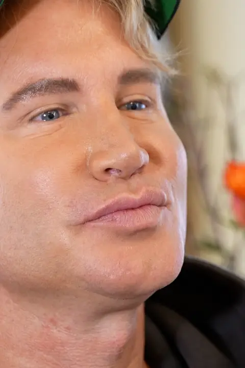 Český Ken šel pod kudlu na stejný zákrok jako Dara Rolins: K faceliftu přidal i liposukci podbradku a operaci víček 