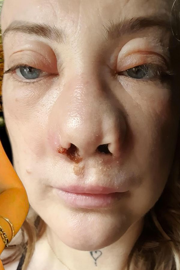 Hollywoodský úsměv z Turecka se změnil v noční můru: Maminka skončila bez zubů, znetvořená a v ukrutných bolestech - fotka 1/1
