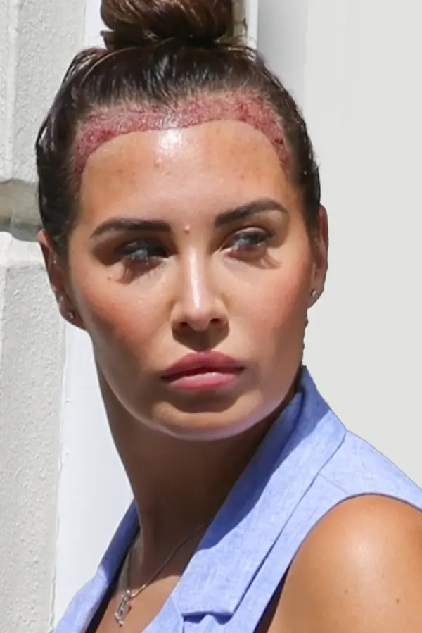 Známá glamour modelka podstoupila transplantaci vlasů: Fotky bude muset teď hodně dlouho retušovat - fotka 1/1
