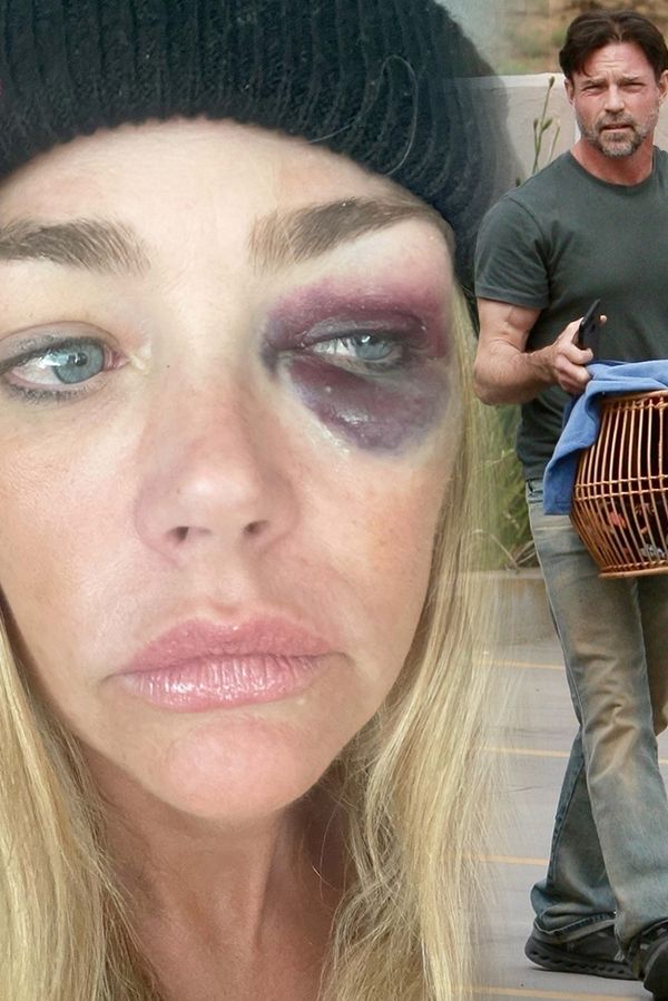 Zmlácená nebo opilá? Denise Richards šokovala fotkami s obrovským monoklem. Nařkla manžela, který se s ní chce rozvést - fotka 1/1