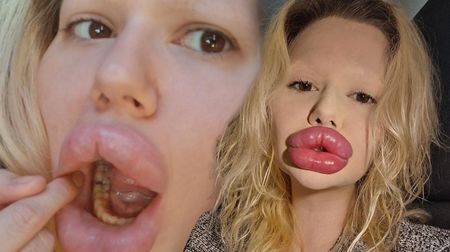 Žena s klobásami místo rtů si zlomila zub. Zubaři ji odmítli ošetřit. Divíte se? 