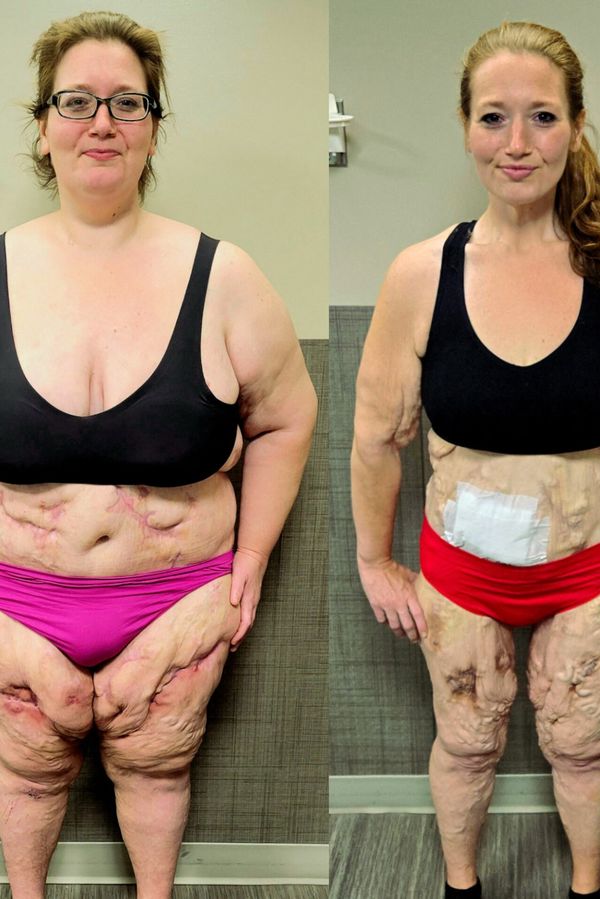 Žena zhubla 140 kilo a hrdě vystavila povislou kůži v plavkách. Kvůli vzácnému onemocnění ale do bazénu nemůže - fotka 1/1
