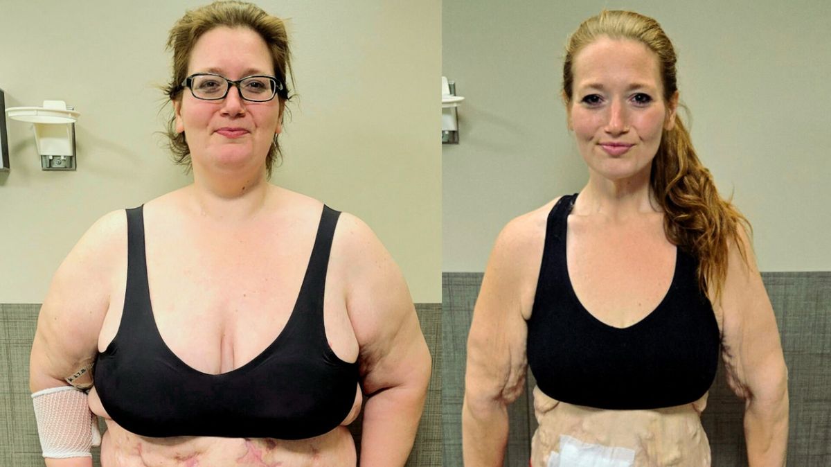 Žena zhubla 140 kilo a hrdě vystavila povislou kůži v plavkách. Kvůli vzácnému onemocnění ale do bazénu nemůže