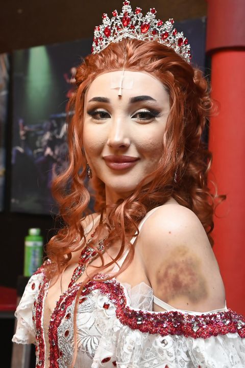 Ta vypadá: Natálie Grossová si v divadle nejdřív zlomila nos, teď má obří podlitinu na paži