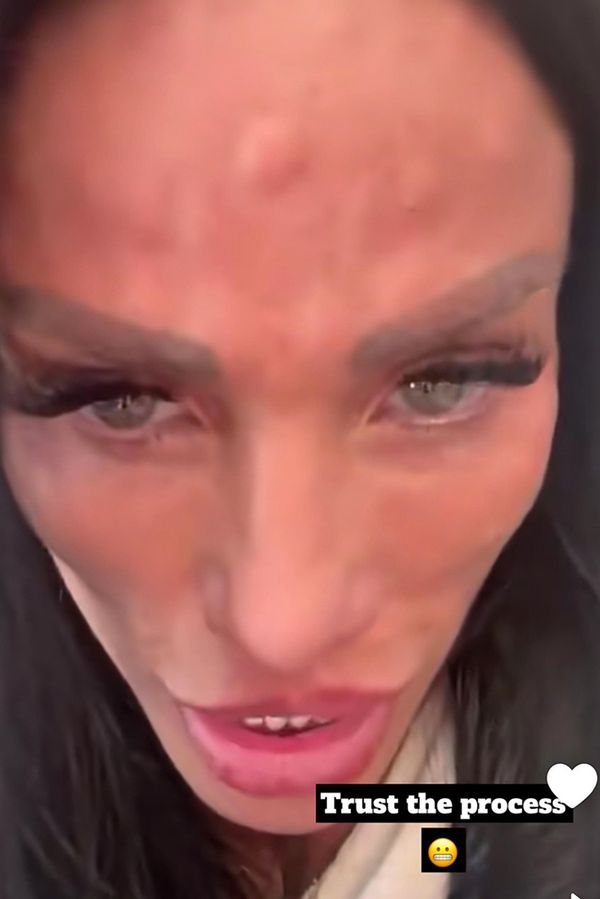 I takhle můžete dopadnout po botoxu do čela: Katie Price se na čele objevily nevzhledné boule - fotka 1/1