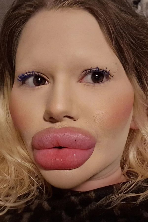 U 30 doktorů je na černé listině: Odmítají se mě dotknout, stěžuje si žena s údajně největšími rty na světě - fotka 1/1