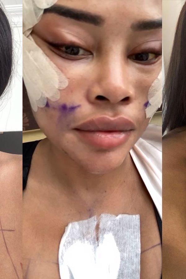 Angličanka utratila skoro milion a půl za facelift ještě před třicítkou: Jsem jako nejlepší verze sebe samé, libuje si - fotka 1/1