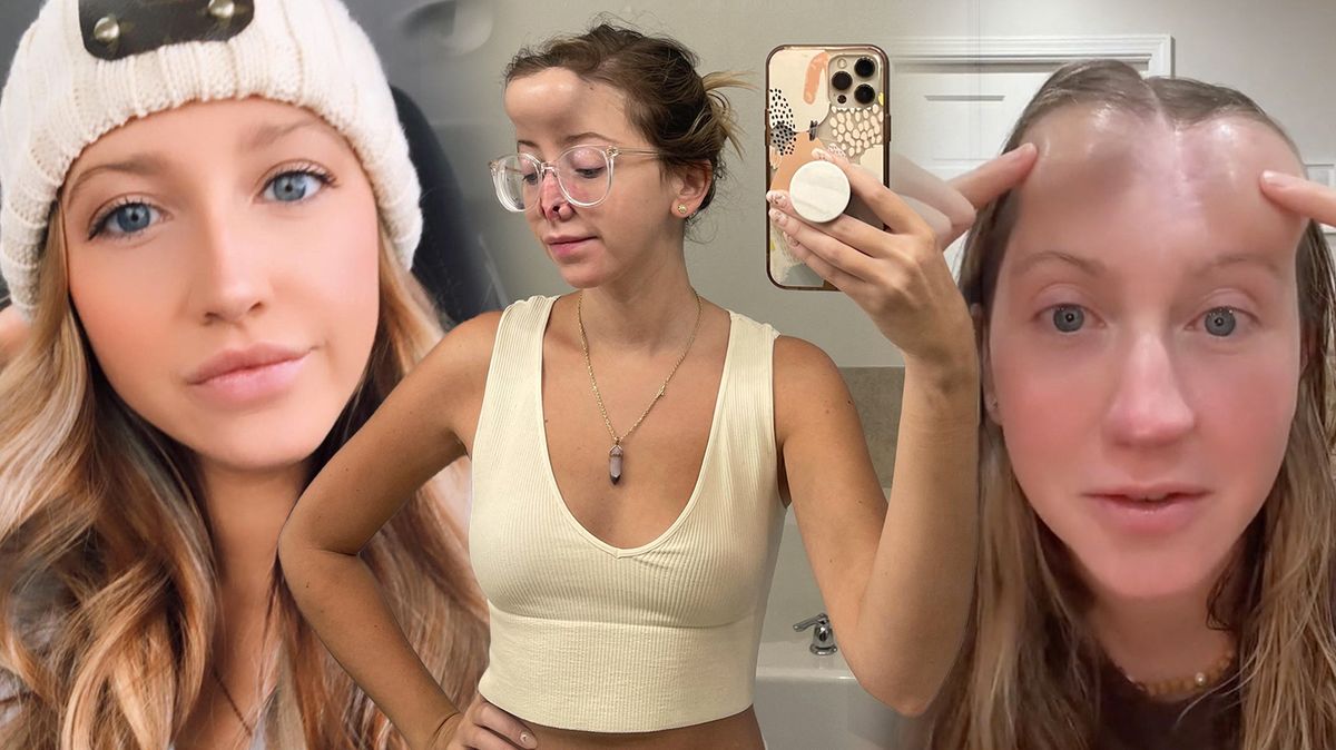 Krásné Jordan pes ukousl nos. Lékaři jí nový ‚vypěstovali‘ na čele. Po 16 operacích se začíná konečně poznávat