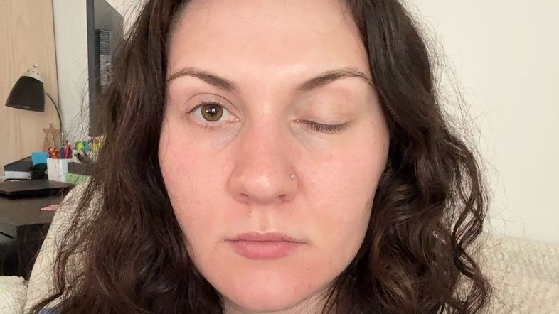 Vsadím se, že můj den je horší než ten váš, napsala influencerka, které po botoxu ochrnulo víčko, a ukázala fotky