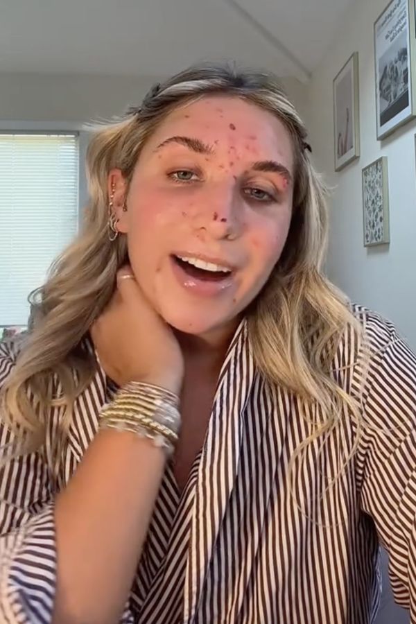 Dívka s vzácnou poruchou tráví hodiny trháním kůže do krve - fotka 1/1