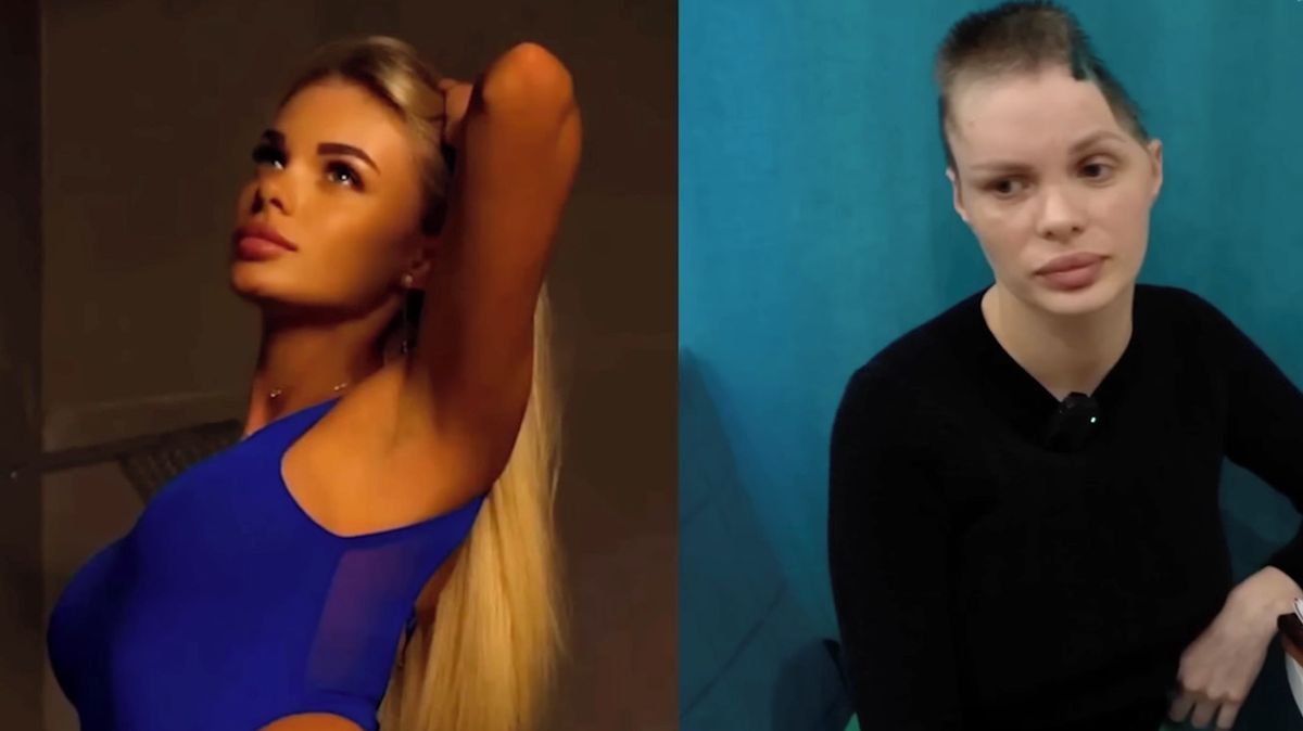 Modelka po brutálním útoku přítele skončila bez části lebky. Zuboženou ji pohodil u silnice, přežila jen zázrakem