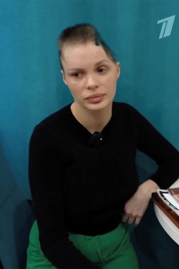 Modelka po brutálním útoku přítele skončila bez části lebky. Zuboženou ji pohodil u silnice, přežila jen zázrakem - fotka 1/1