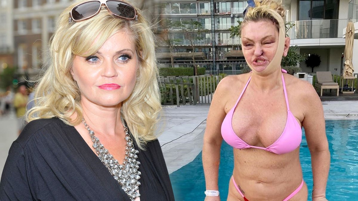 Danniella Westbrook se ukázala po dalším zákroku: Děsí nejen obličejem, ale i zpackanou plastikou ňader!
