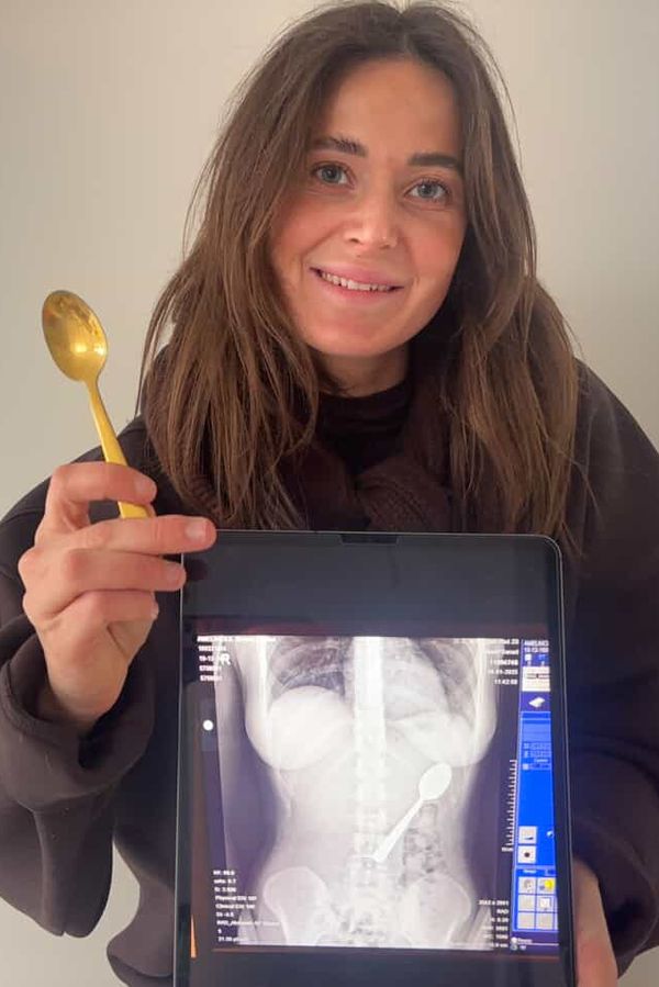 Dívka spolkla 17 cm dlouhou lžičku. Šlo o tak trapnou nehodu, že se o tom styděla říct i příteli - fotka 1/1