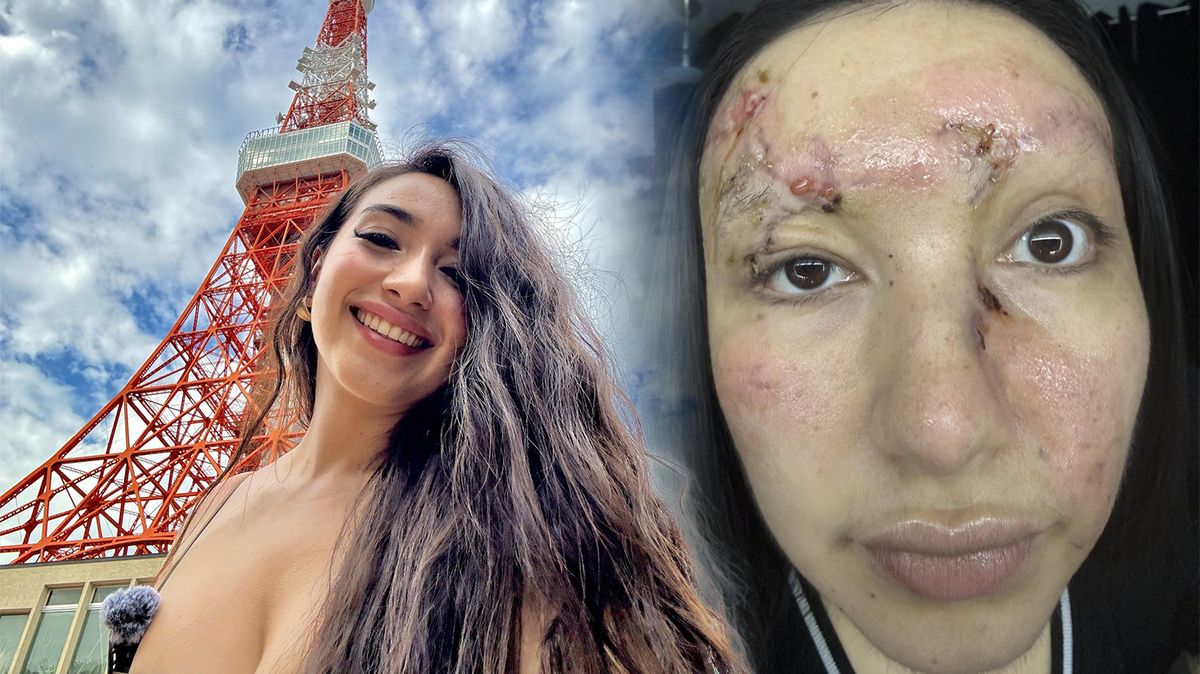 Rychlá jízda bez pásů se krásné influencerce vymstila: Po bouračce skončila se zdevastovaným obličejem