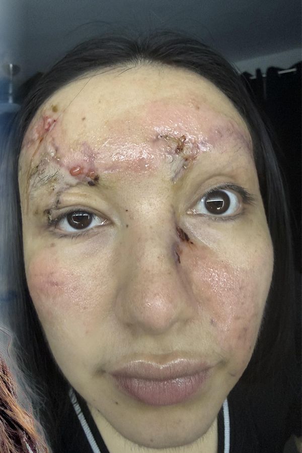 Rychlá jízda bez pásů se krásné influencerce vymstila: Po bouračce skončila se zdevastovaným obličejem - fotka 1/1