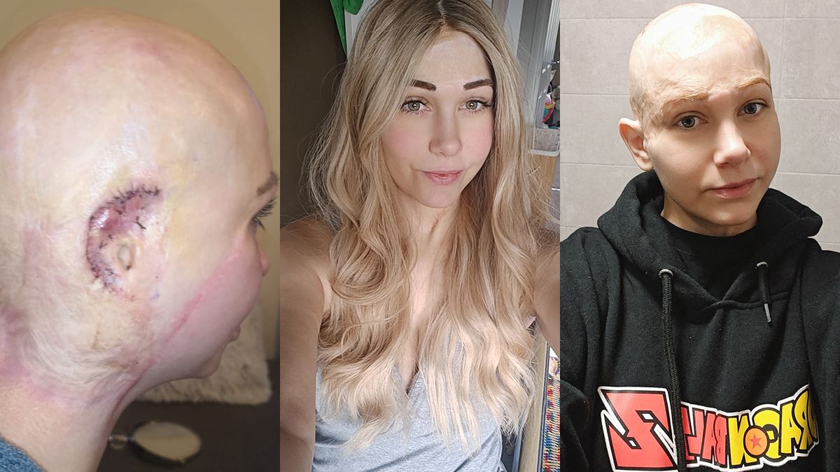 Hrůza v práci: Mladou maminku skalpoval stroj. Nepoznávaly ji ani její děti