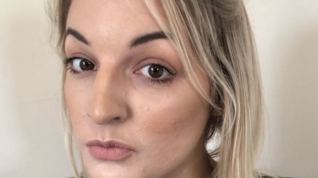 Sophie Purvis popsala následky běžných krémů: „Byla jsem jako smažené kuře“ a ukázala fotky. Měla pocit, že hoří zaživa