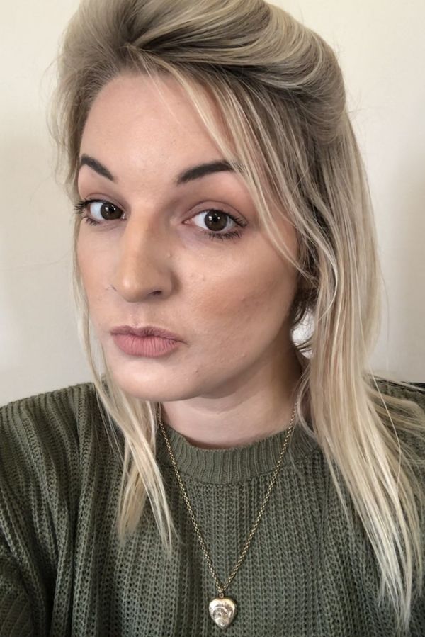  Sophie Purvis popsala následky běžných krémů: „Byla jsem jako smažené kuře“ a ukázala fotky. Měla pocit, že hoří zaživa - fotka 1/1