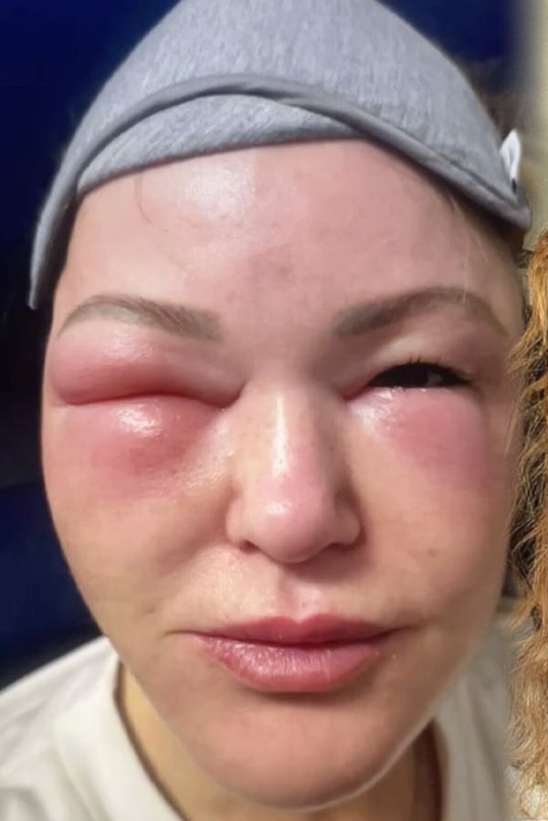 Překrásnou učitelku po autonehodě zasáhla krutá nemoc. Kvůli otokům mívá hlavu jako balón - fotka 1/1