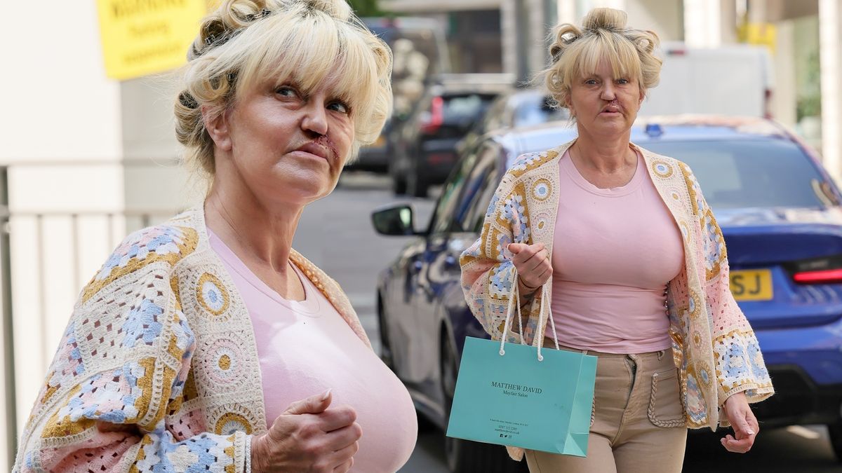 Herečka, která prošňupala miliony, podstoupila další operaci. Pořád vypadá, jako by ji praštili lopatou, míní fanoušci