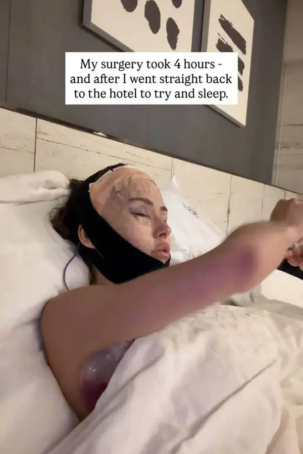 Místo očí škvírky: Influencerka ukázala oteklý obličej po kosmetickém zákroku. Nepoznal ji ani chytrý telefon - fotka 1/1